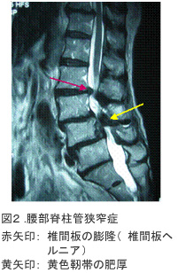 図2．腰部脊柱管狭窄症