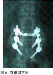 図4．脊椎固定術