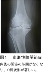 図1．変形性膝関節症